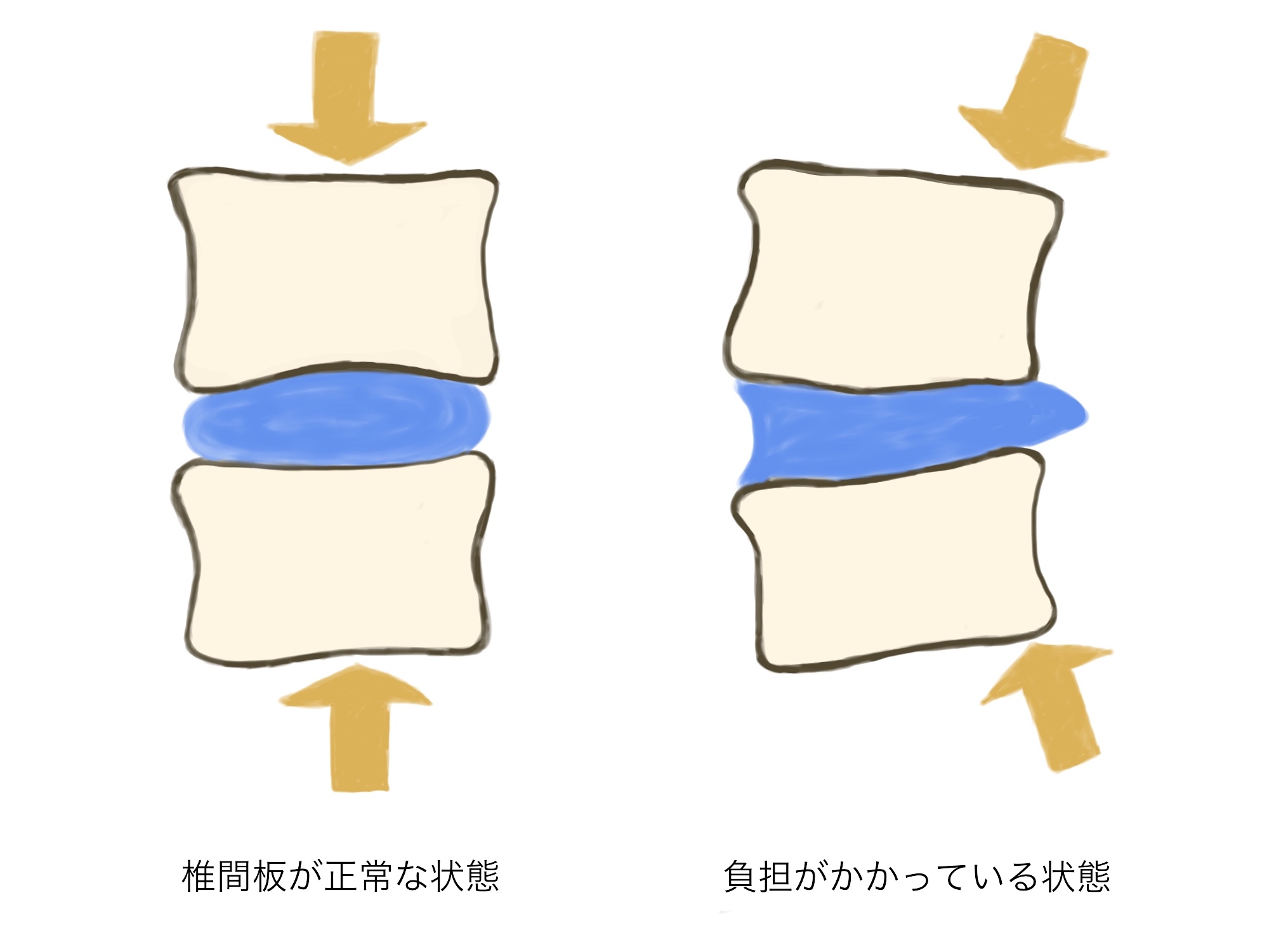 椎間板とマットレス